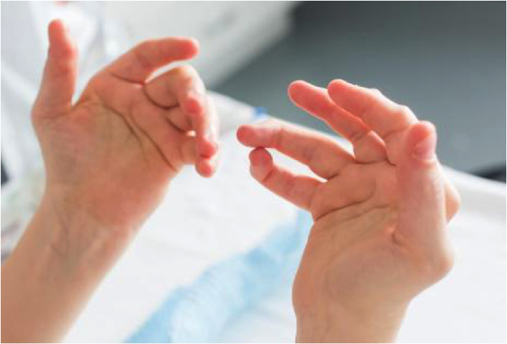 La Polyarthrite Rhumatoïde : Mes doigts sont gonflés !