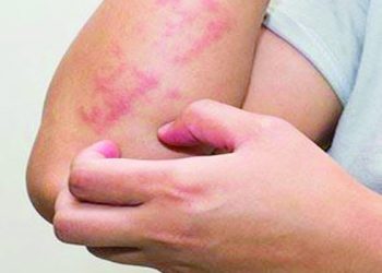 Cas de gale dans le milieu scolaire  :  « Situation maîtrisée » , selon le ministère de la Santé 